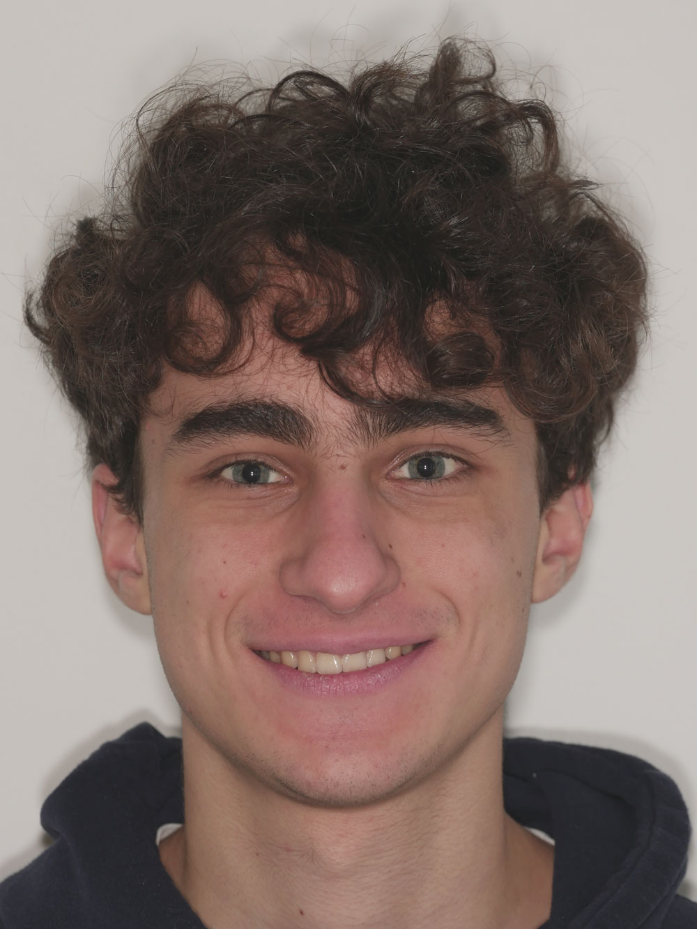 Allineatori trasparenti. Dopo il trattamento